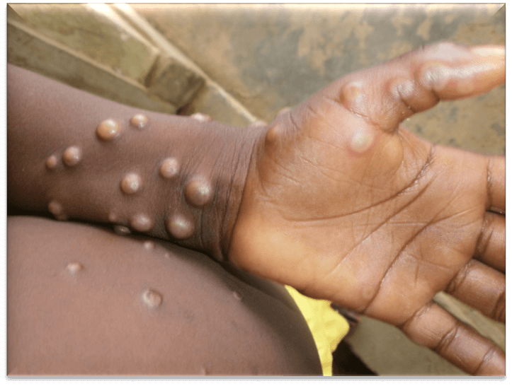 bforblogs Monkeypox: Causes, Symptoms, Treatment and Prevention